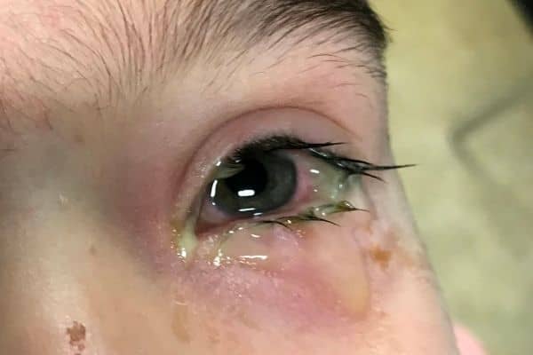 pink-eye-in-toddlers-symptoms-diagnosis-and-treatment