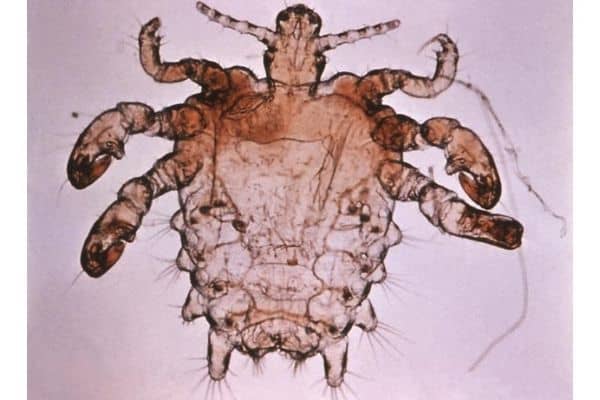 Pubic crab lice louse blepharitis phthiriasis palpebrarum.