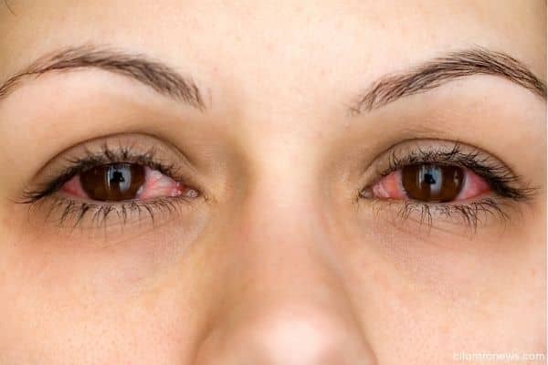 How To Get Rid Of Pink Eye Fast