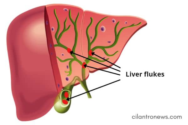 Bile ducts obstructed (blocked) from liver flukes.