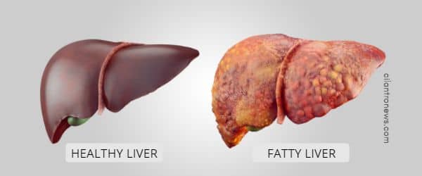 Liver flukes cause fatty liver.