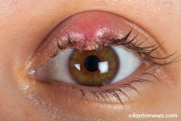 How I Cured My Blepharitis With Honey Cilantro News 