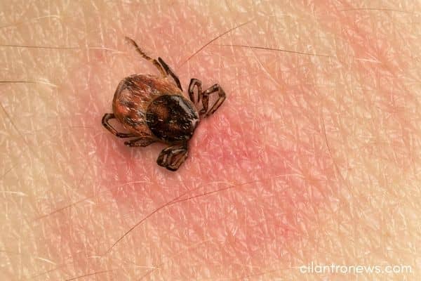 3 Best Natural Home Remedies For Ticks